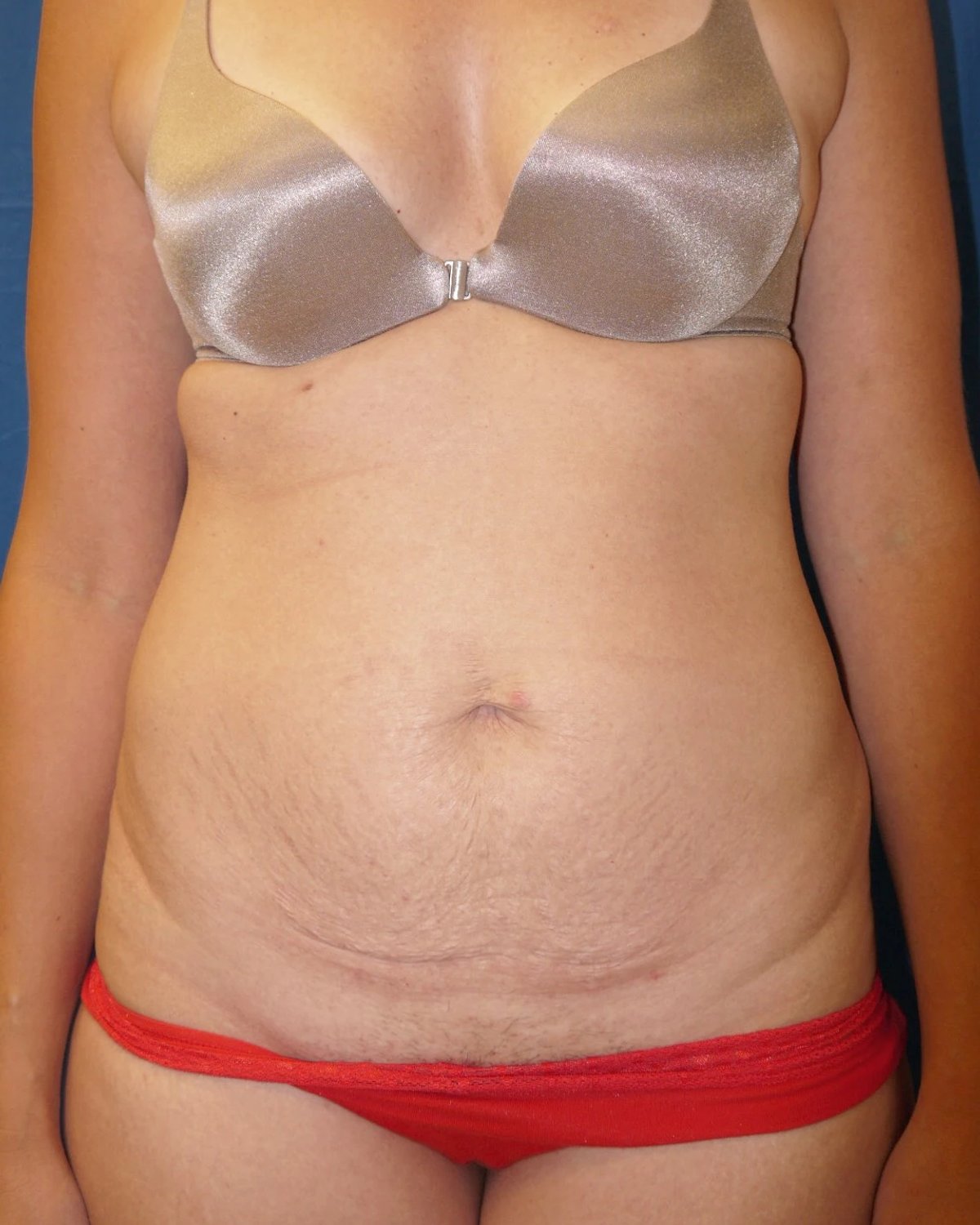 Tummy Tuck before