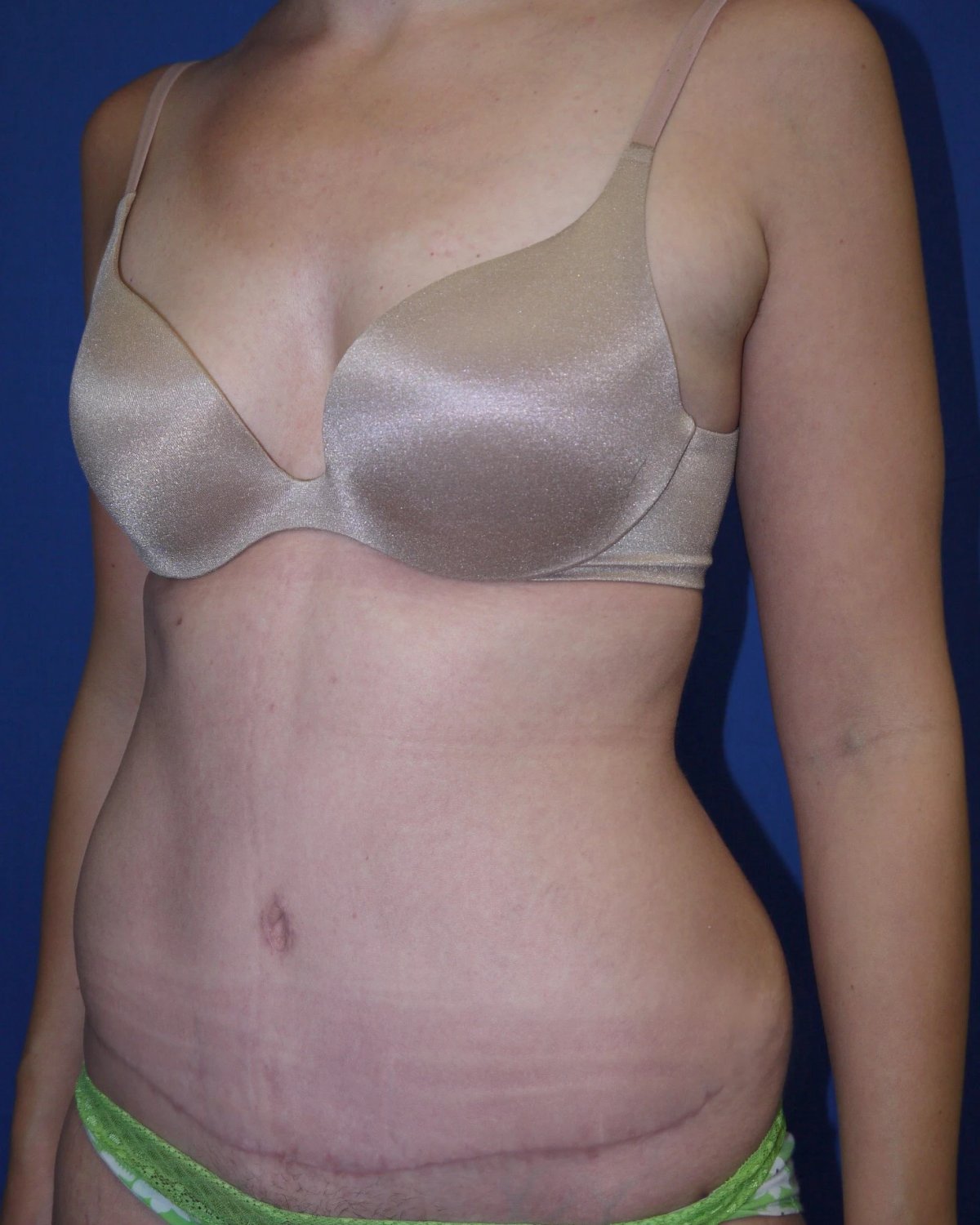 Tummy Tuck — Right Profile view, after