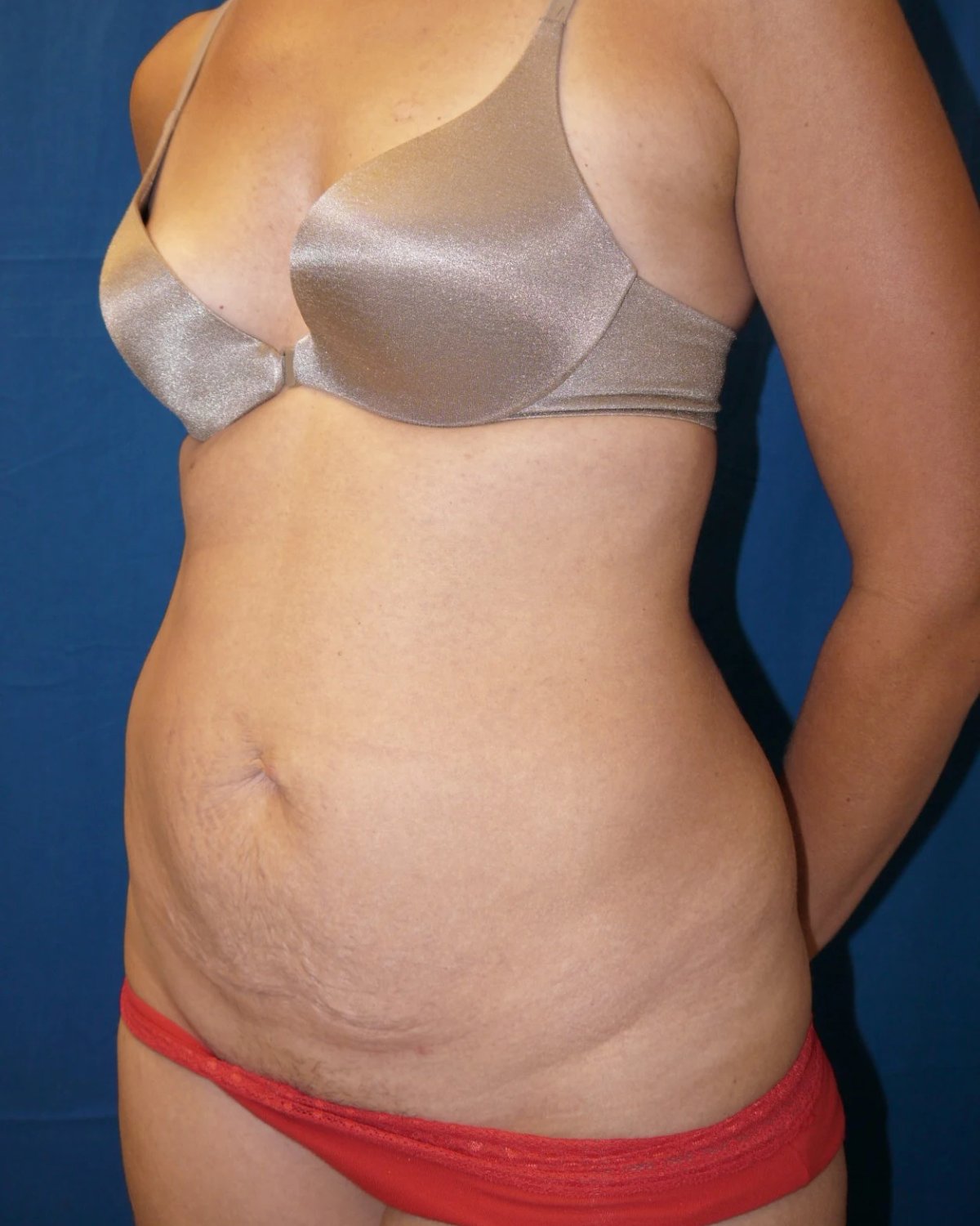 Tummy Tuck — Right Profile view, before