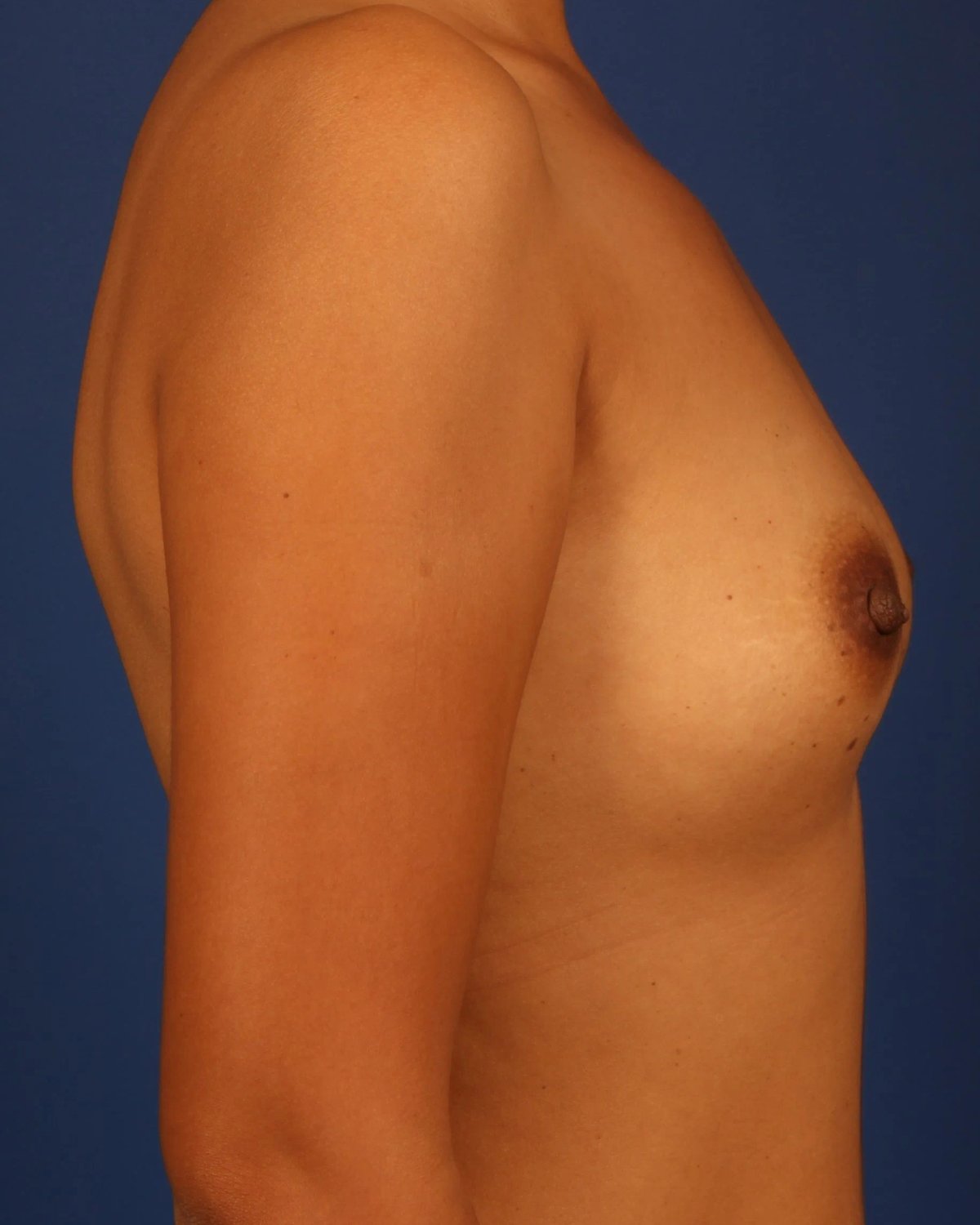 Breast Augmentation with Implants before
