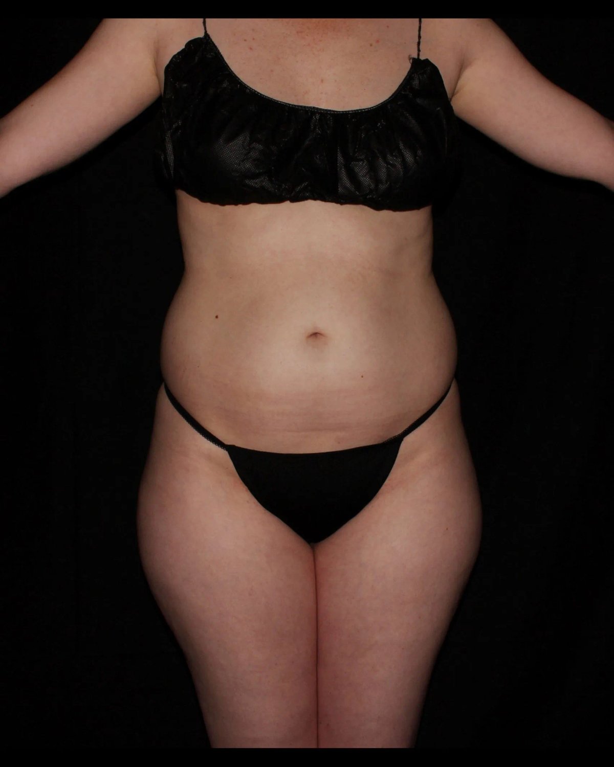 Vaser Lipo 360 (5L Max) before