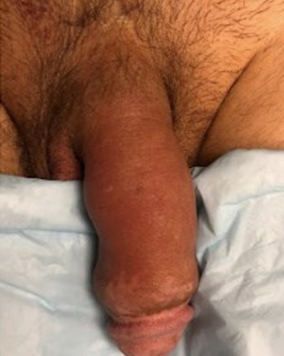 Penis Filler before