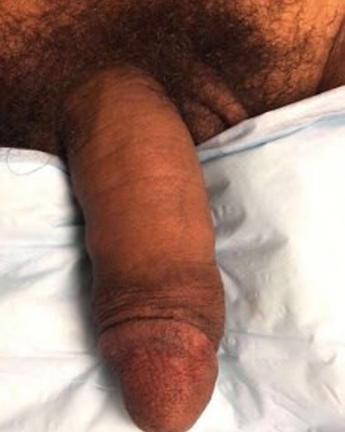 Penis Filler after