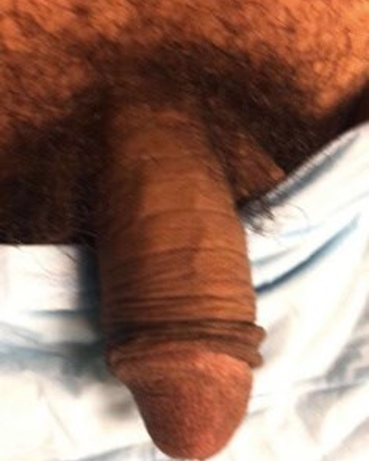Penis Filler before