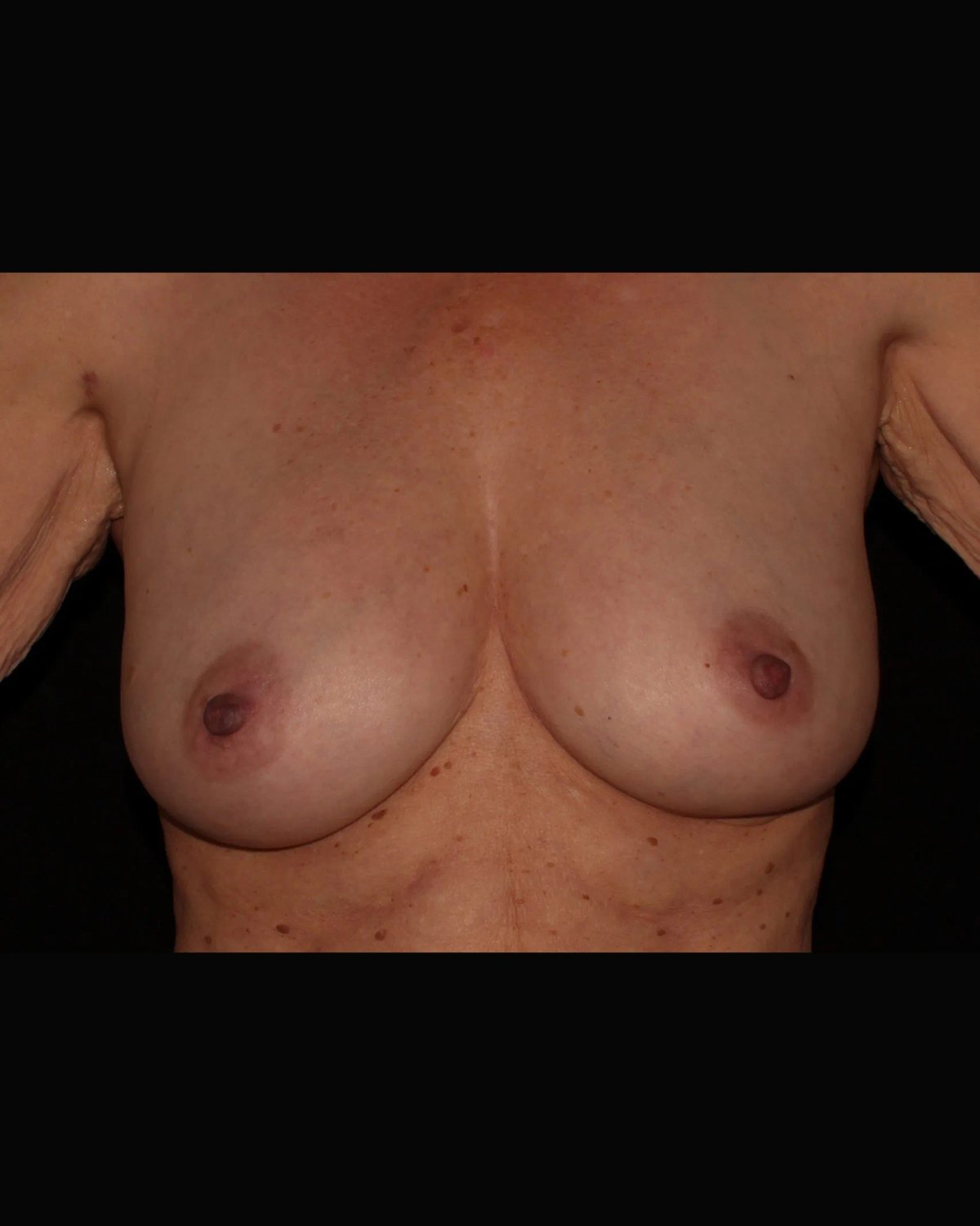 Fat Transfer To the Breast after