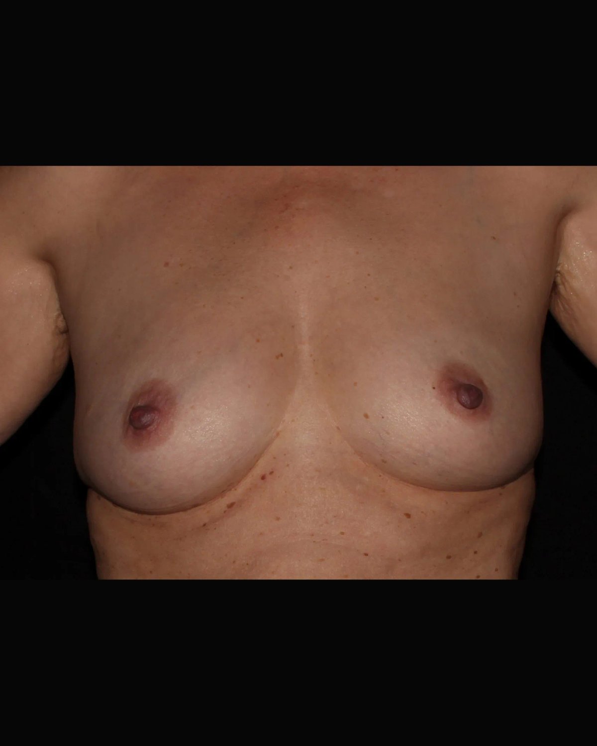 Fat Transfer To the Breast before