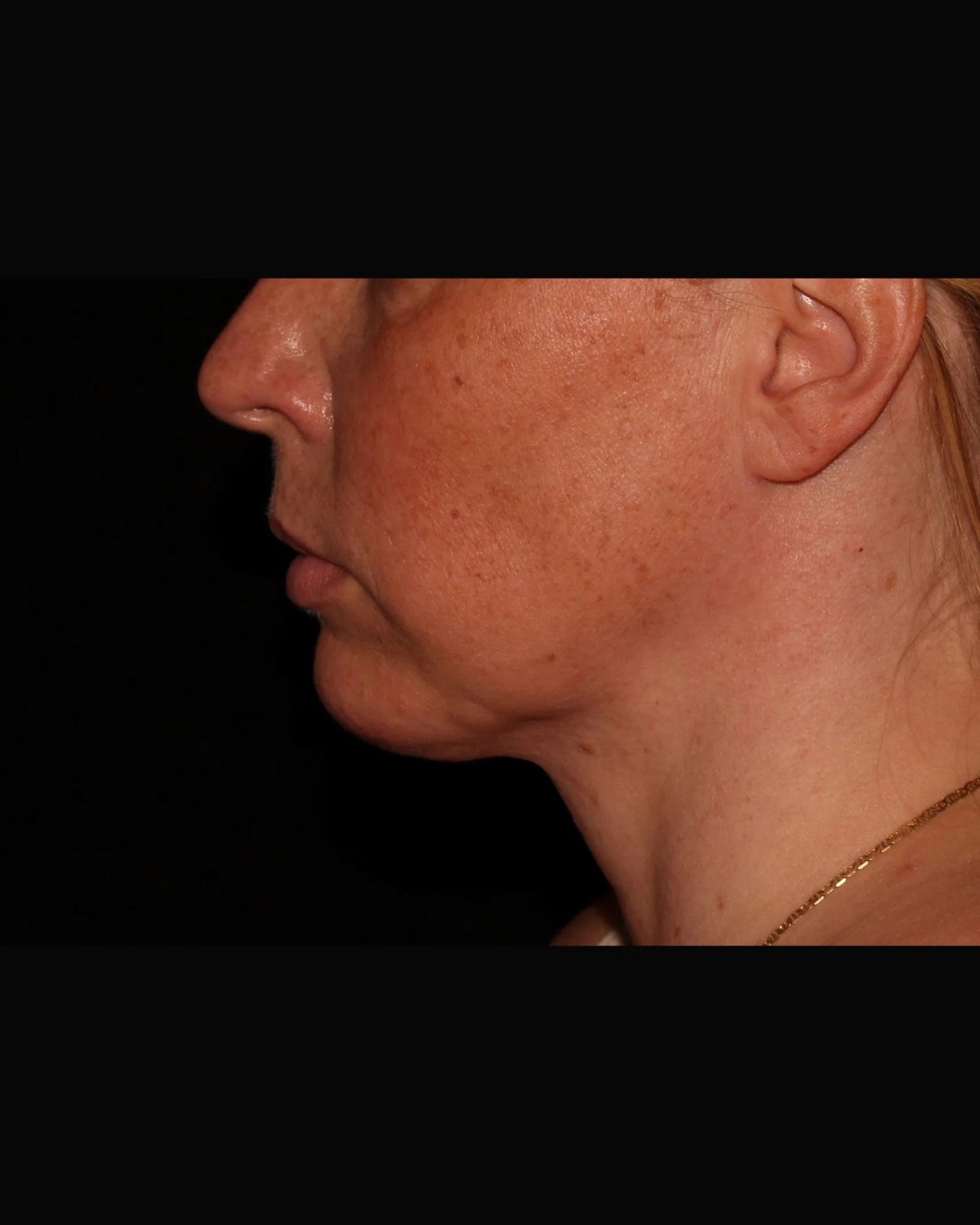 Buccal Fat Pad Removal — Right Profile view, after