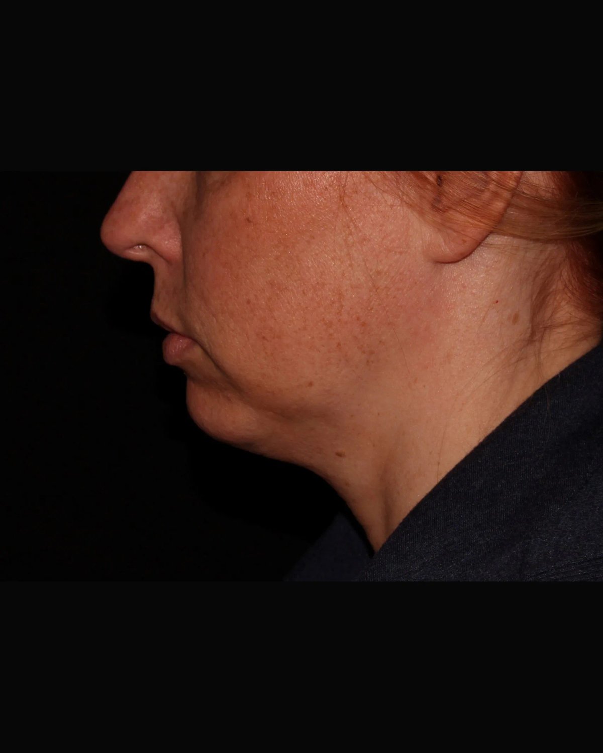 Buccal Fat Pad Removal — Right Profile view, before