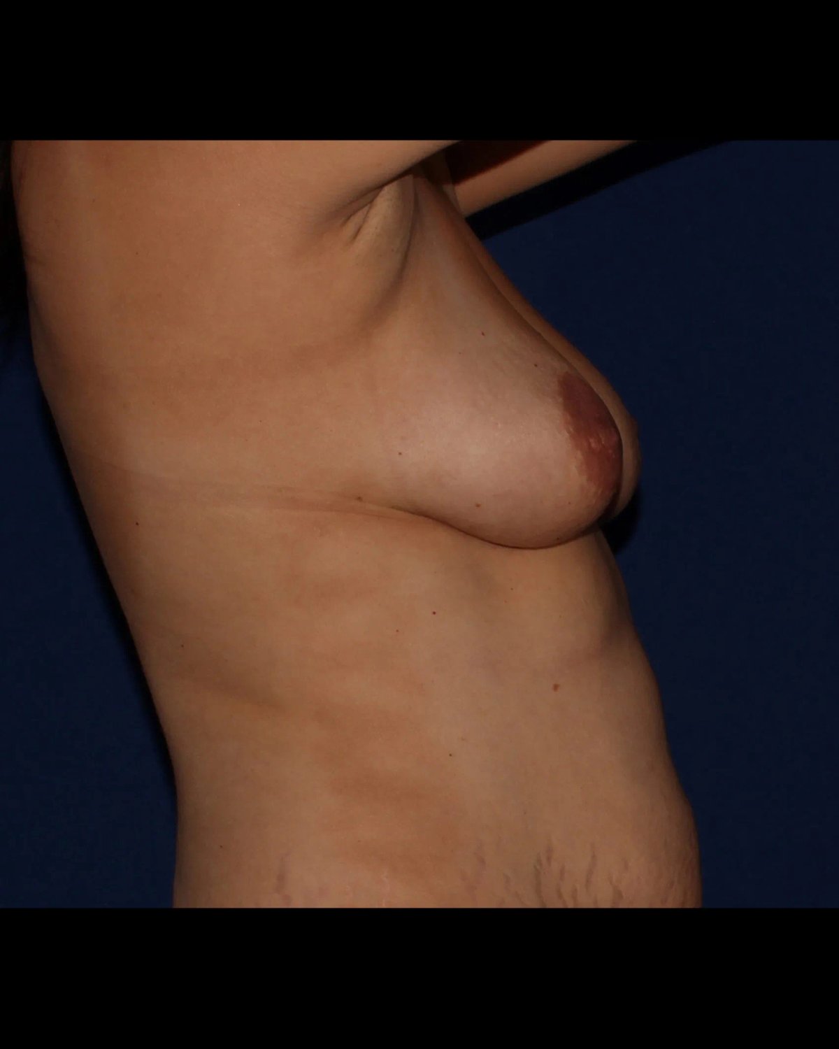 Fat Transfer To the Breast — Right Profile view, before
