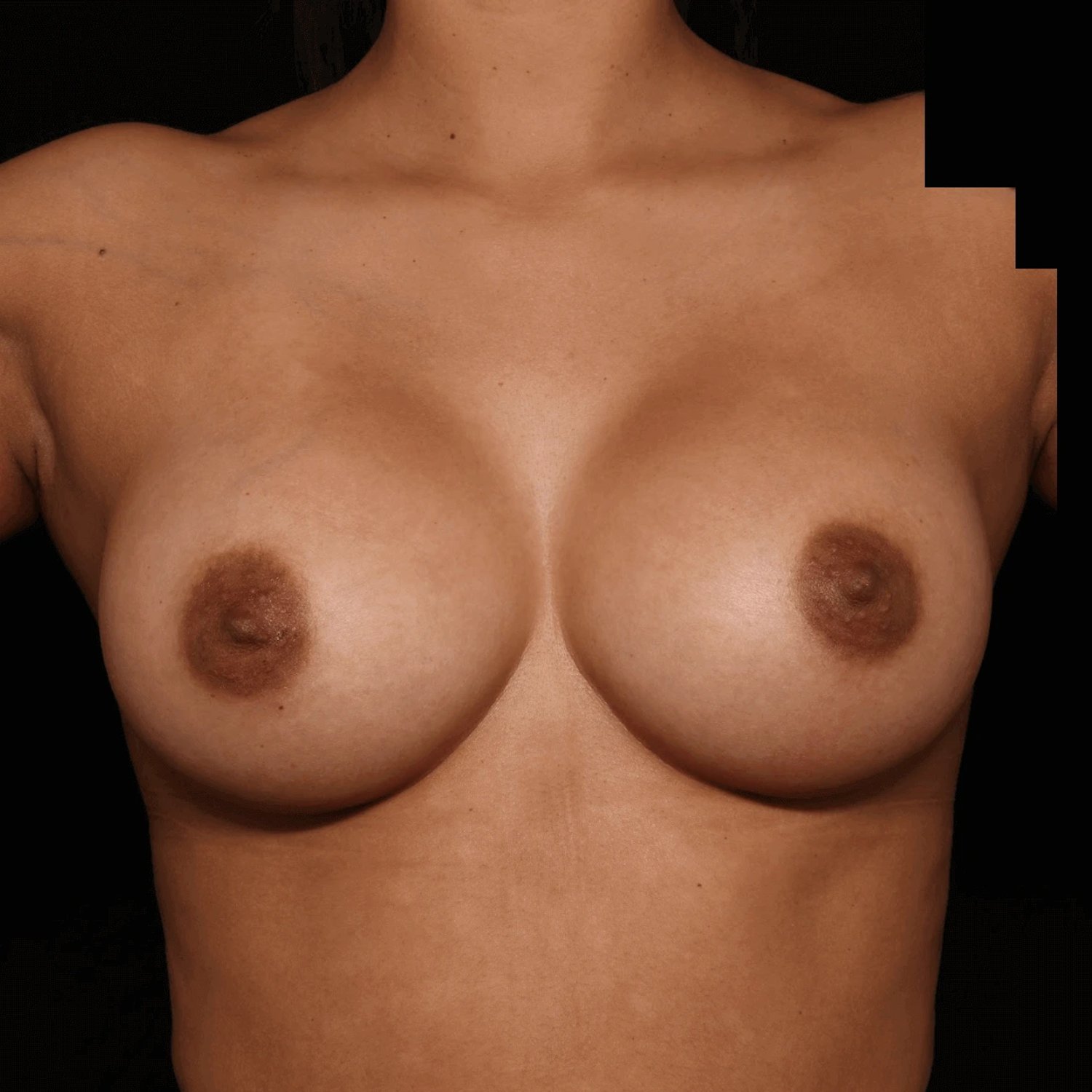 Breast Augmentation with Implants after