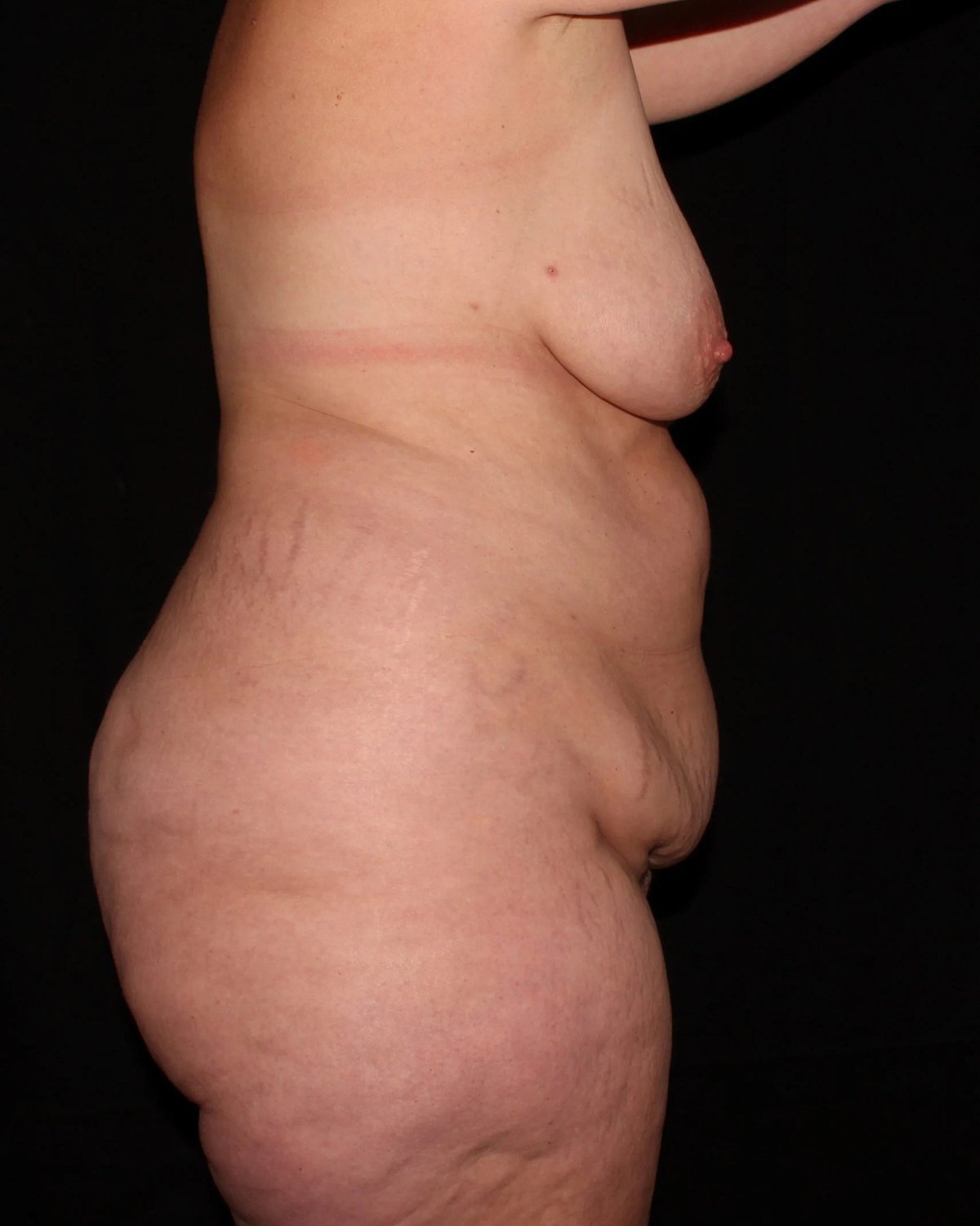 Breast Augmentation with Implants — Right Profile view, before