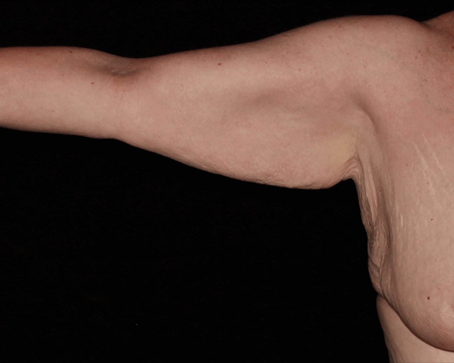 Arm Lift before