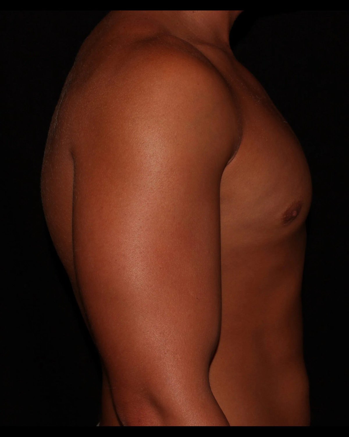 One-Stitch Gynecomastia — Right Profile view, after