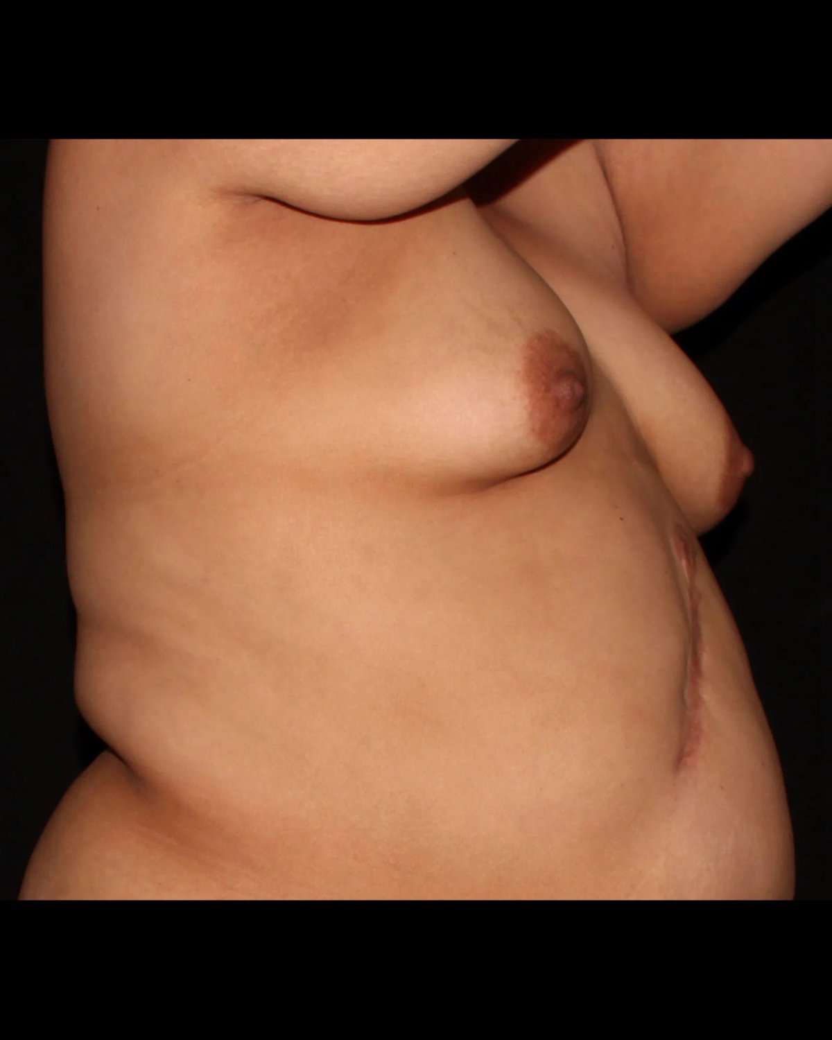 Fat Transfer To the Breast — Right Profile view, before
