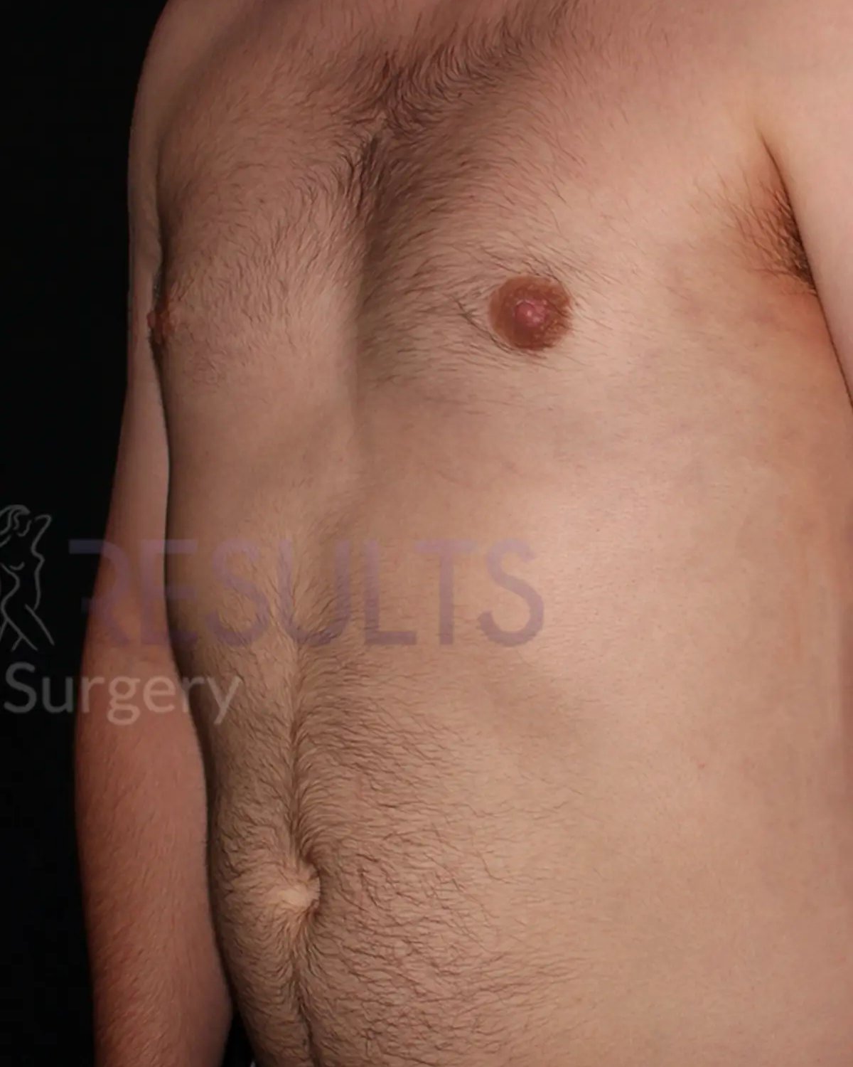 After One-Stitch Gynecomastia