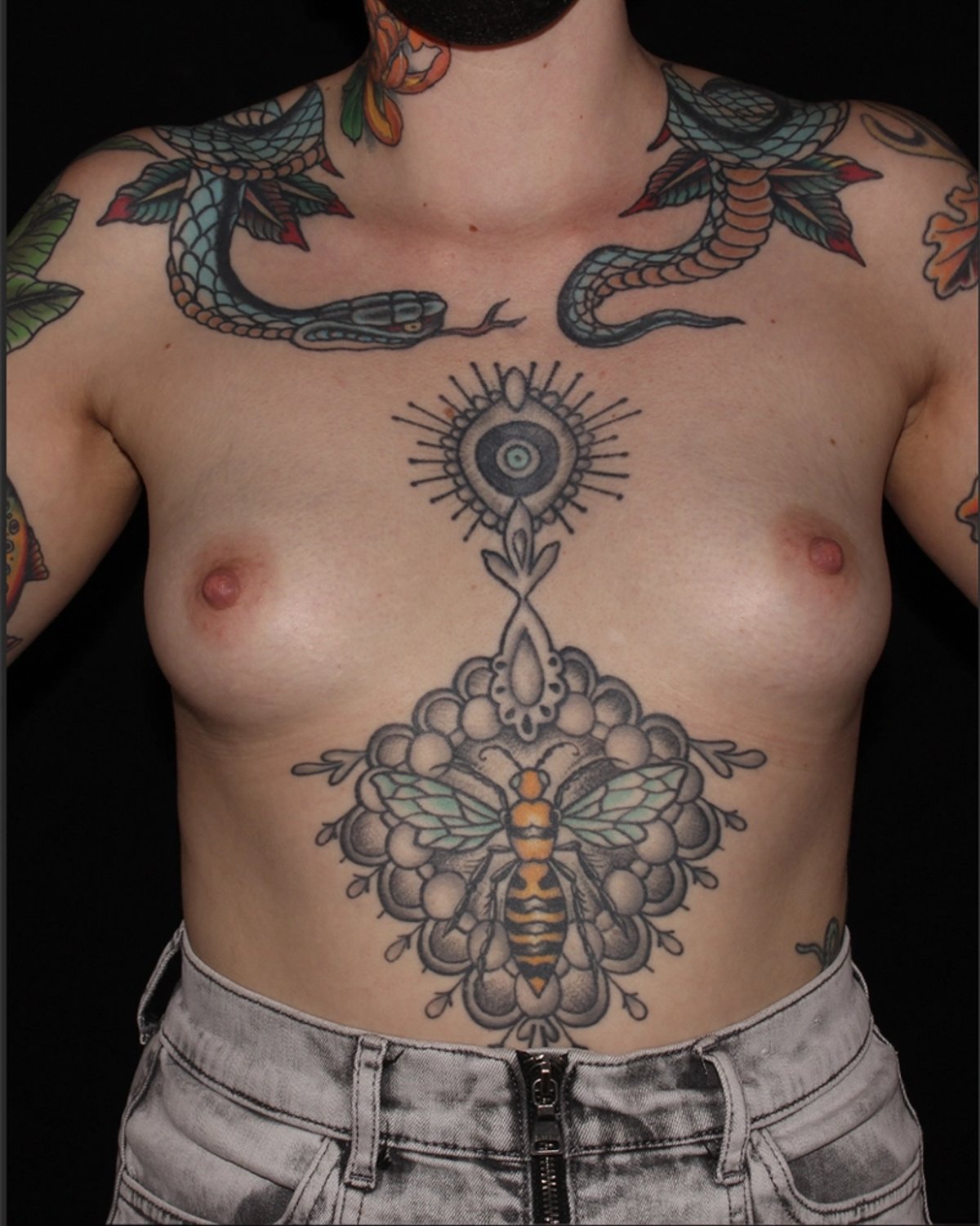 Breast Augmentation with Implants before