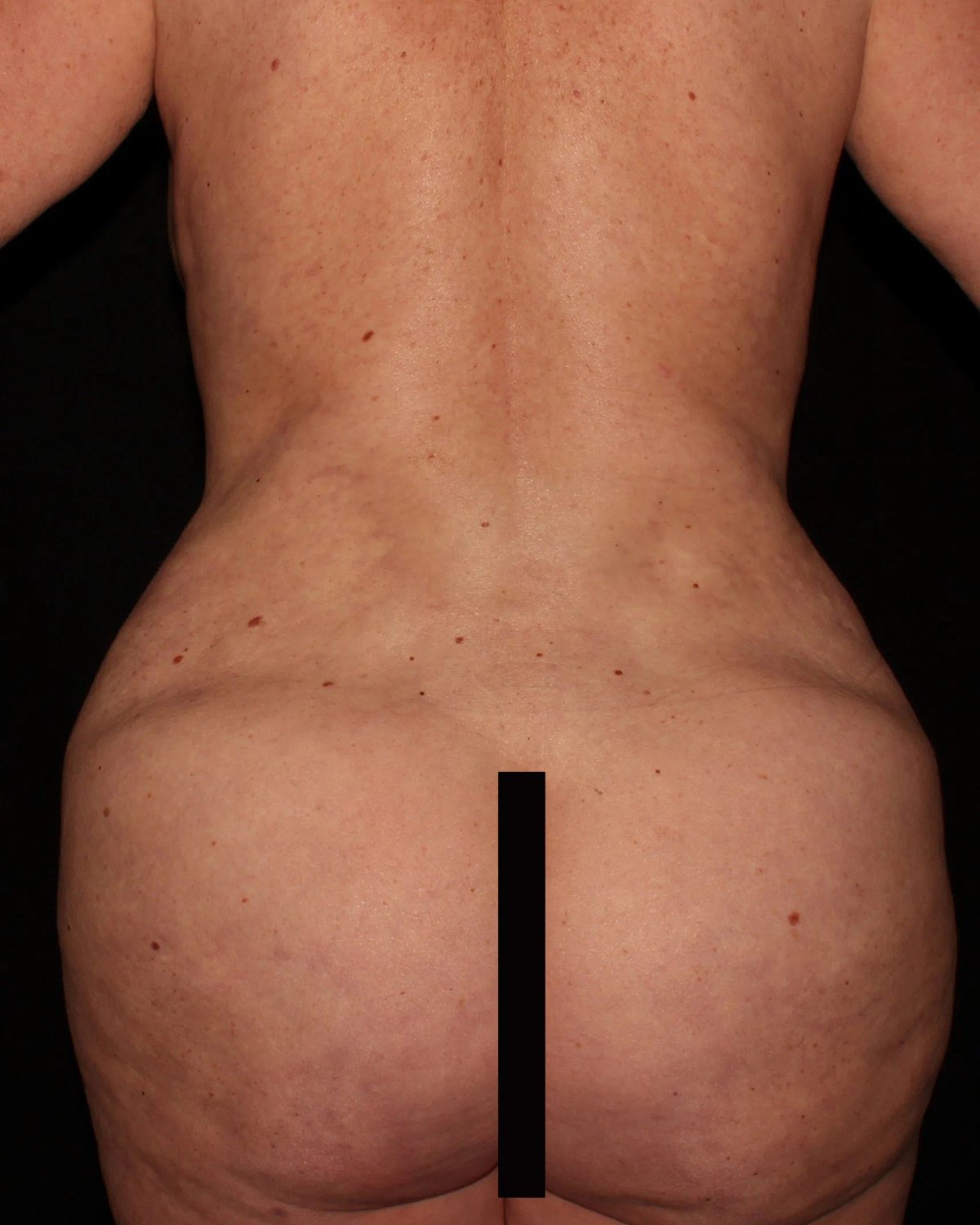 Breast Augmentation with Implants — Back view, after