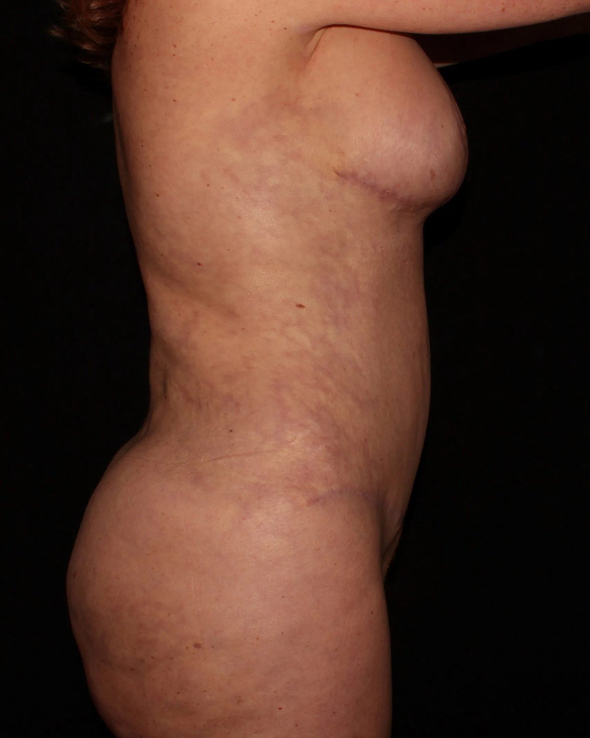 Breast Augmentation with Implants — Right Profile view, after