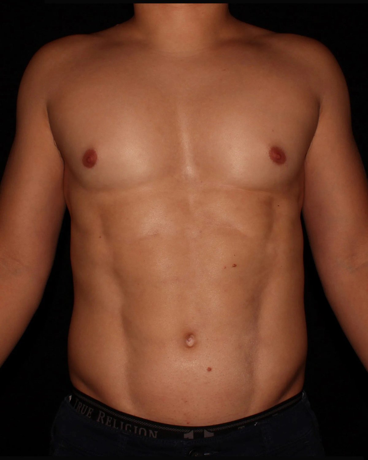 Vaser Lipo 360 (5L Max) after