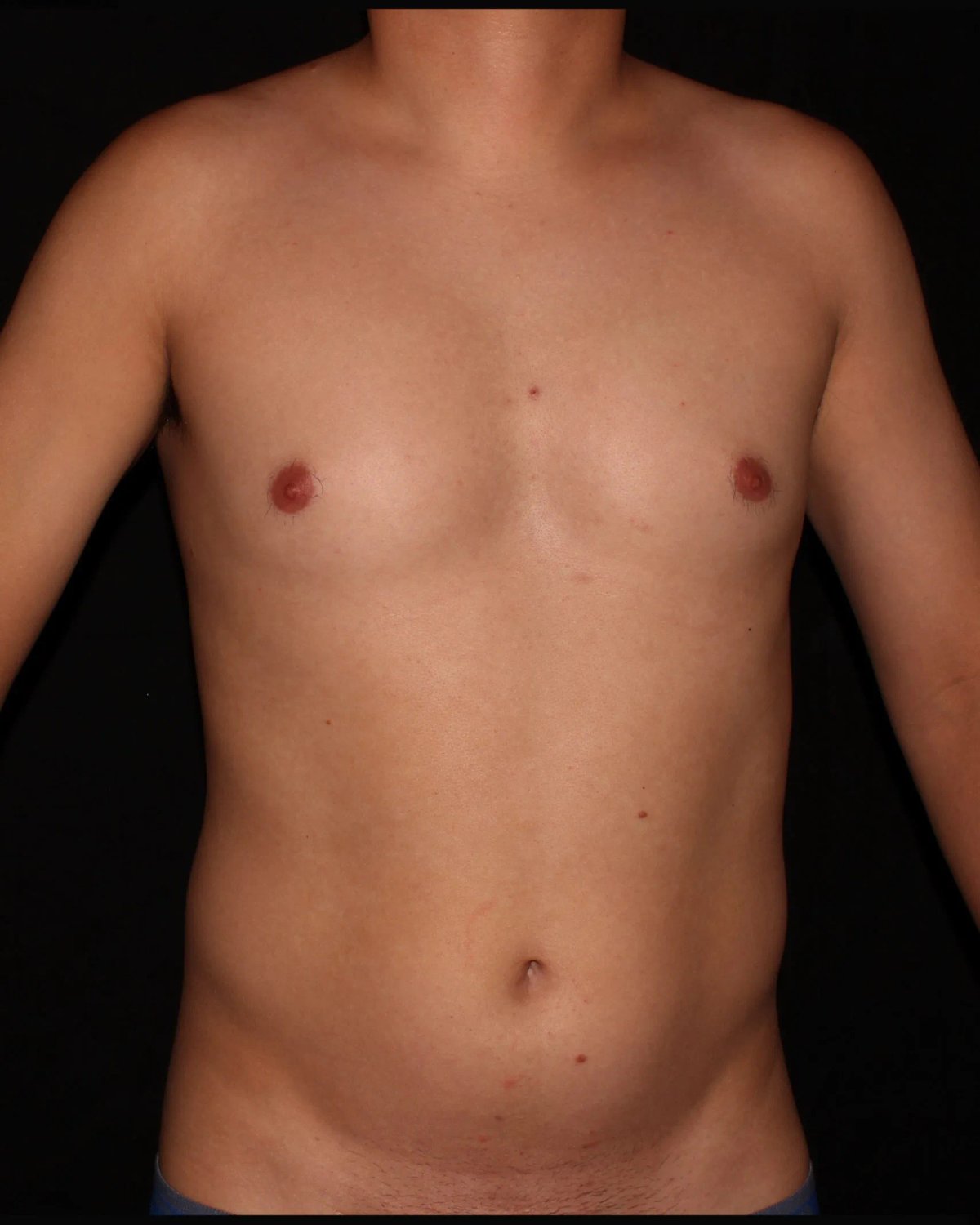 Vaser Lipo 360 (5L Max) before