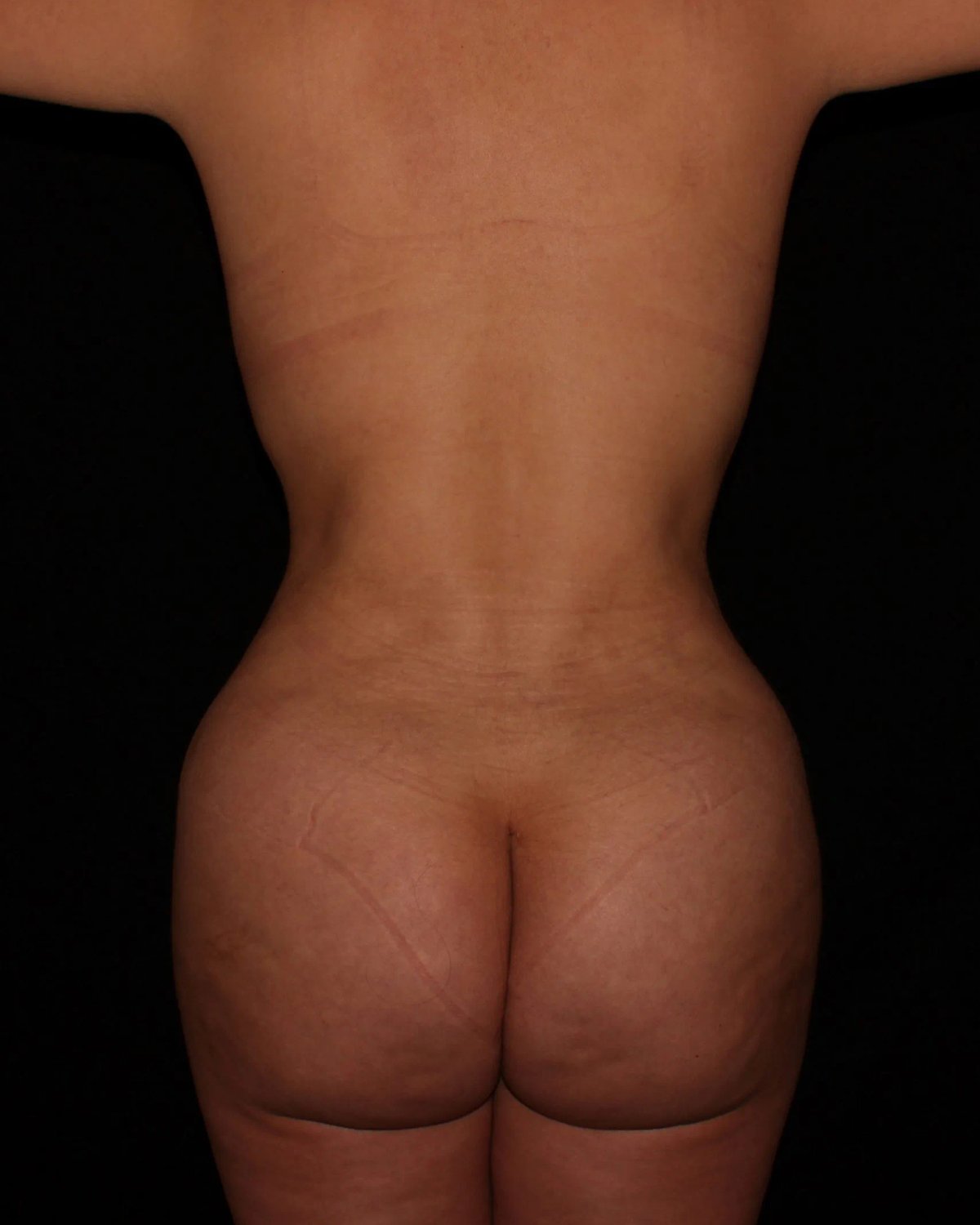 Breast Augmentation with Implants — Back view, after
