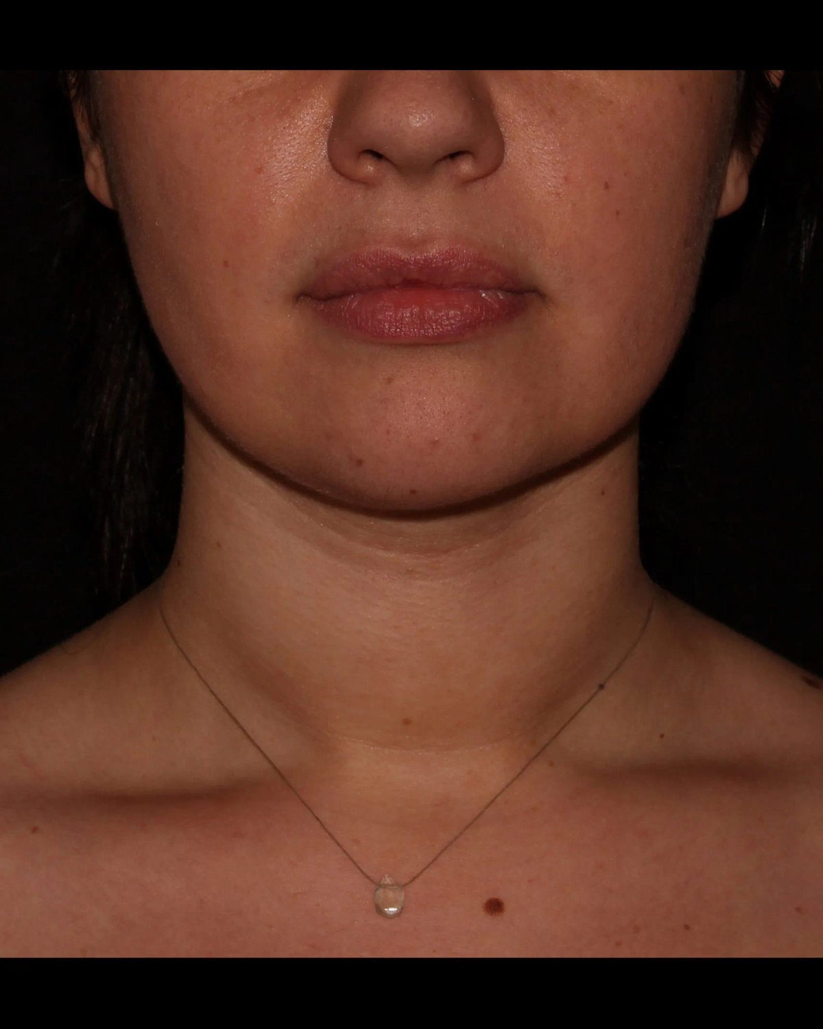 Buccal Fat Pad Removal after