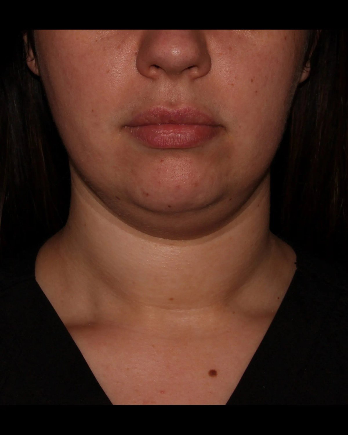 Buccal Fat Pad Removal before