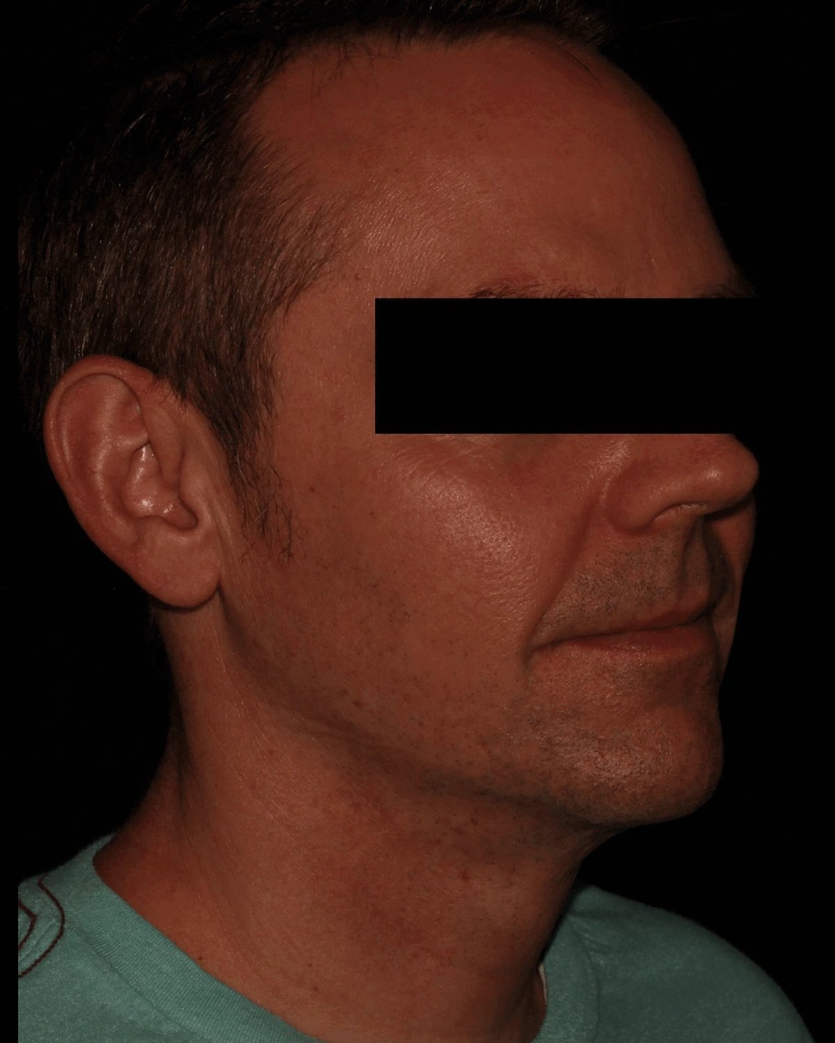 Neck Liposuction w/ Magic Tight after