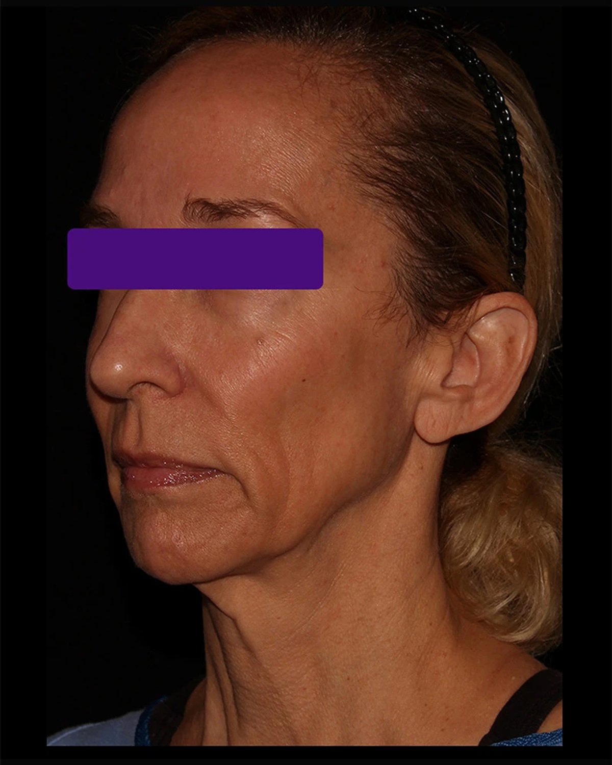 Before Facelift (neck lift included)