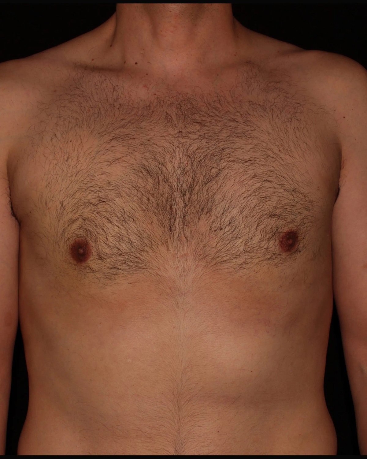 One-Stitch Gynecomastia after