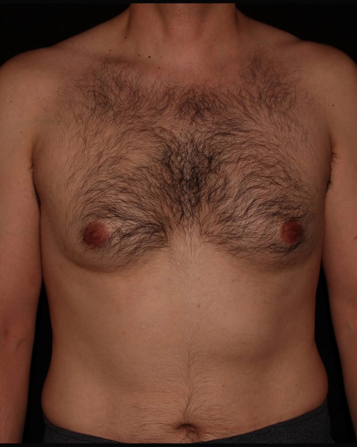One-Stitch Gynecomastia before