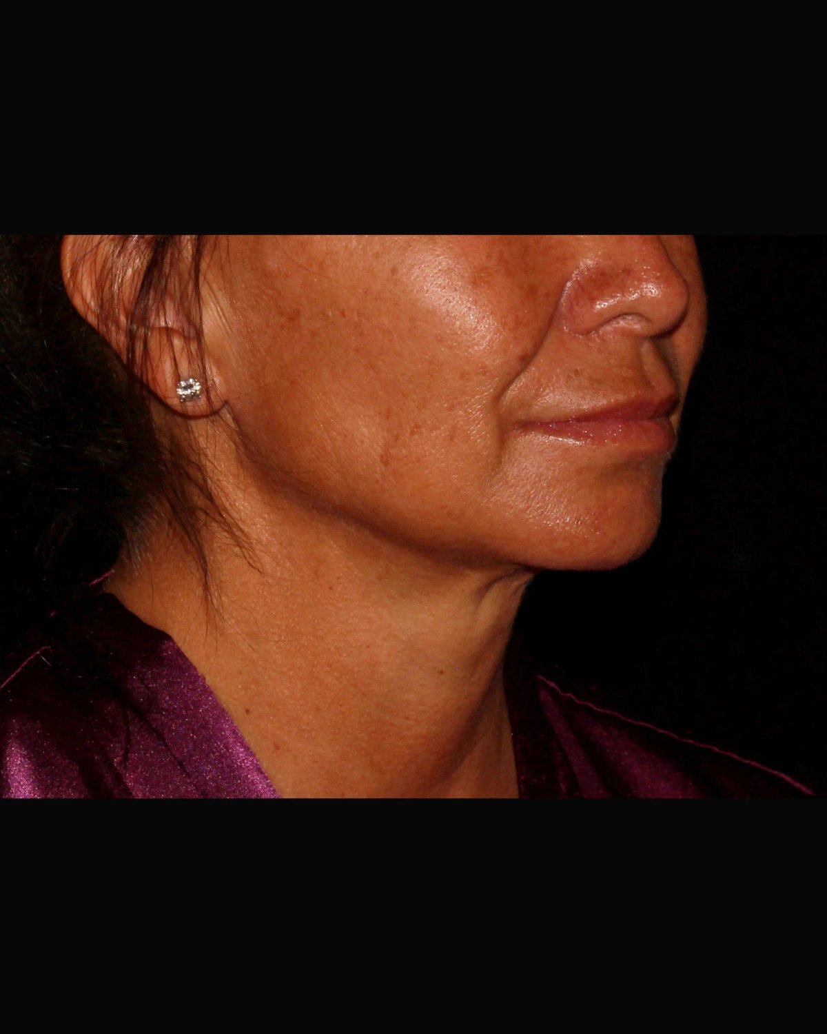 Neck Liposuction w/ Magic Tight after