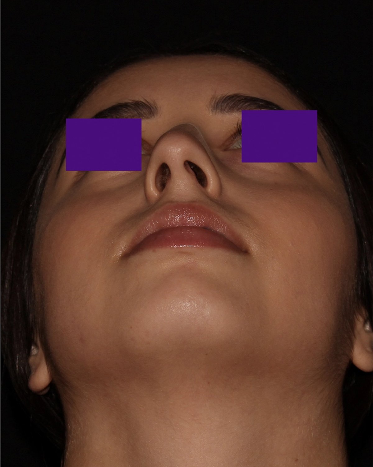 Before Rhinoplasty