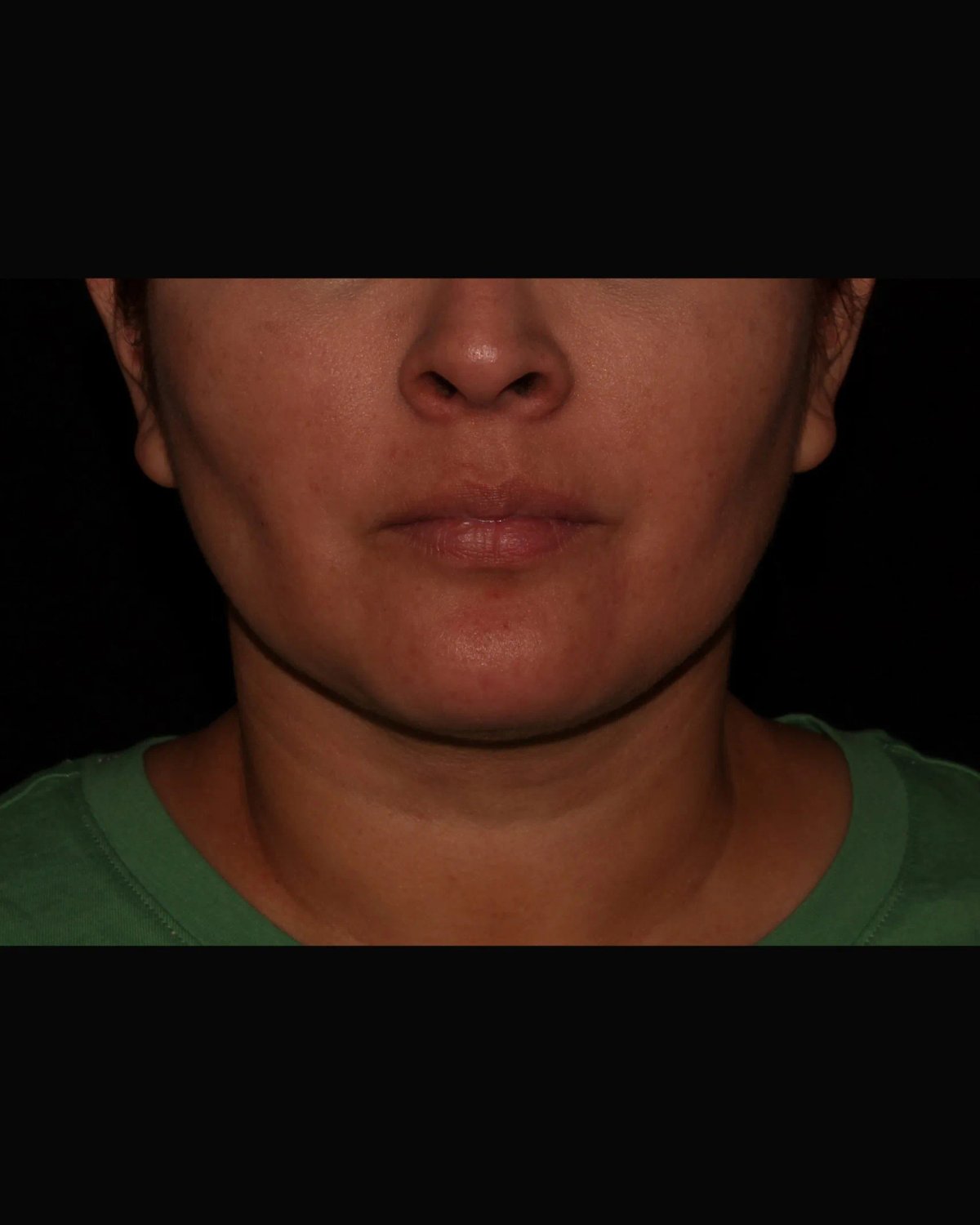 Buccal Fat Pad Removal after