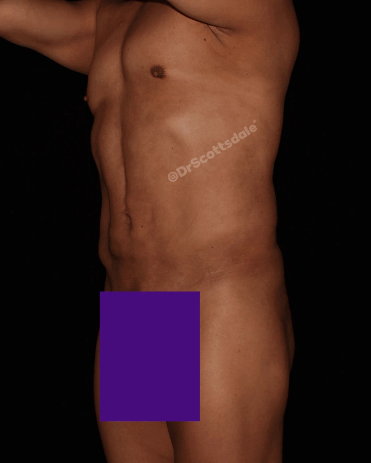 Vaser Lipo 360 (5L Max) after