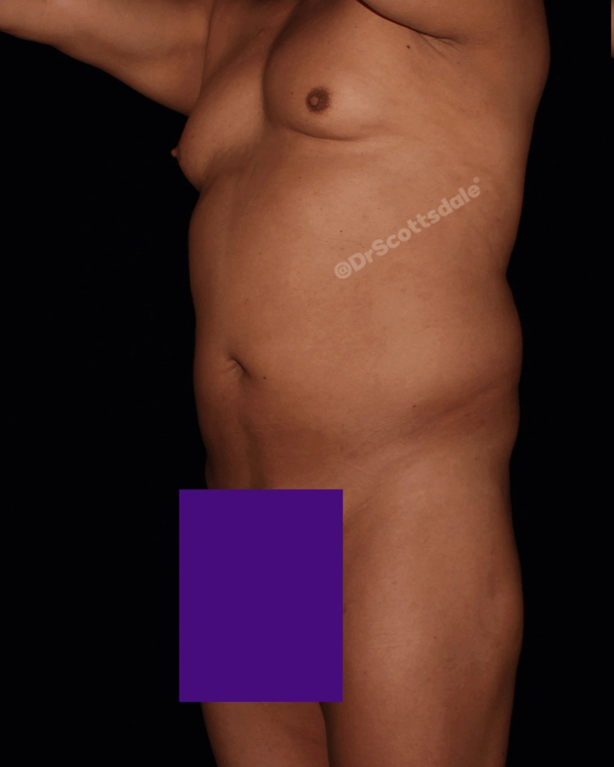 Vaser Lipo 360 (5L Max) before