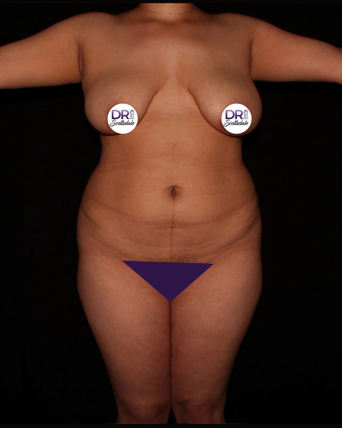 Vaser Lipo 360 (5L Max) before