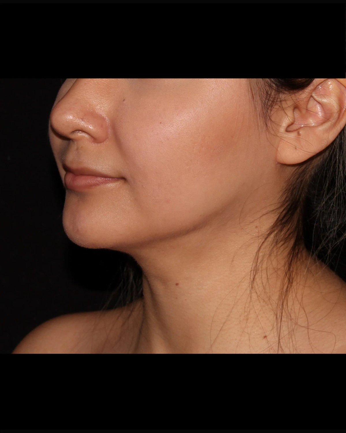 Neck Liposuction w/ Magic Tight — Oblique Right view, after