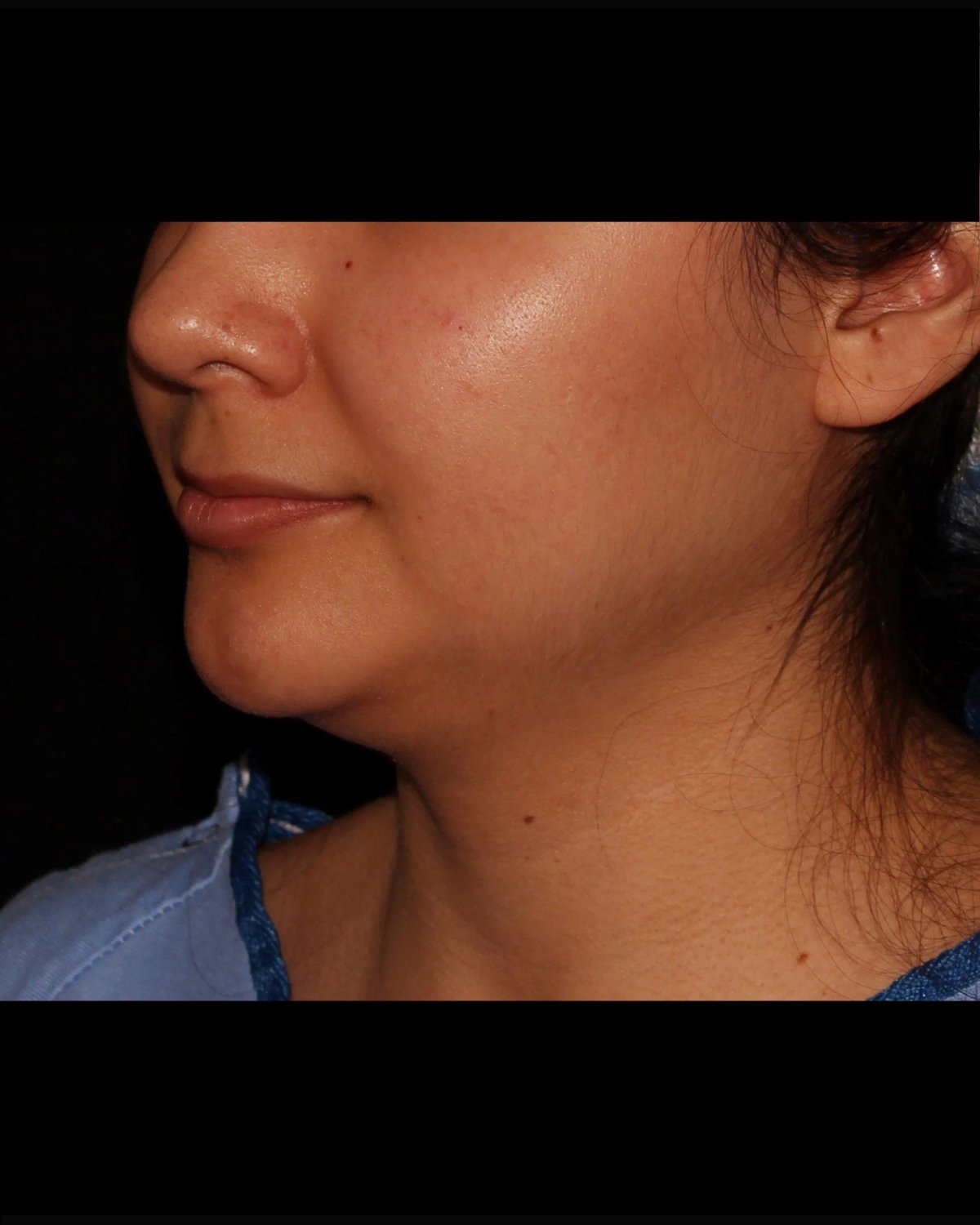Neck Liposuction w/ Magic Tight — Oblique Right view, before
