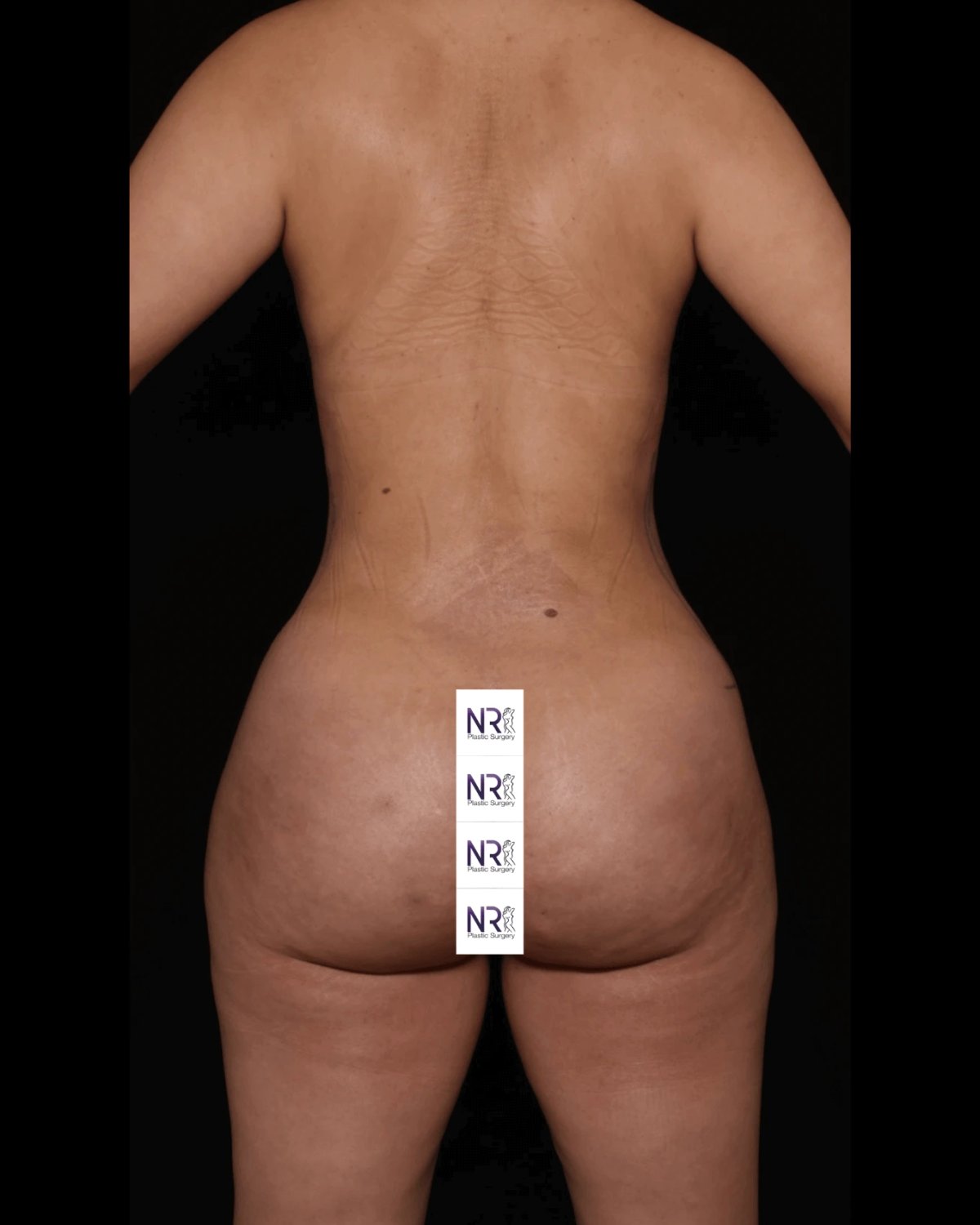 Vaser Lipo 360 (5L Max) after