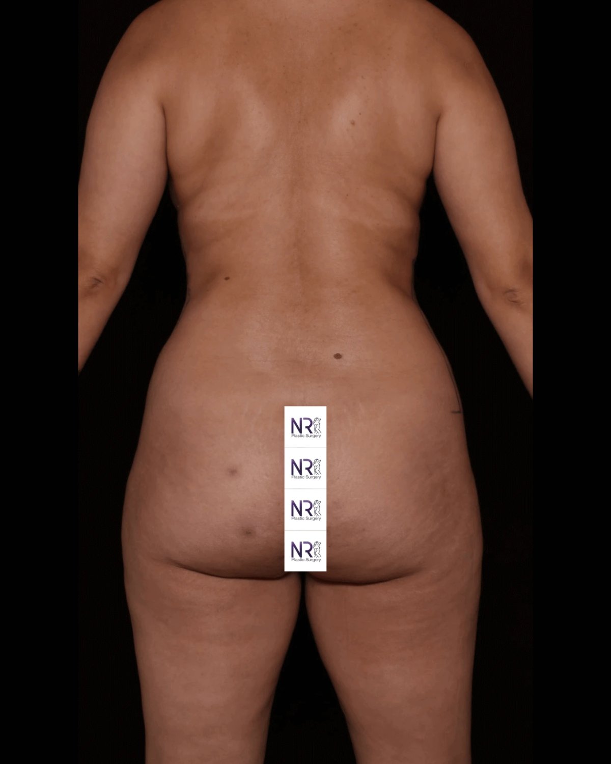Vaser Lipo 360 (5L Max) before
