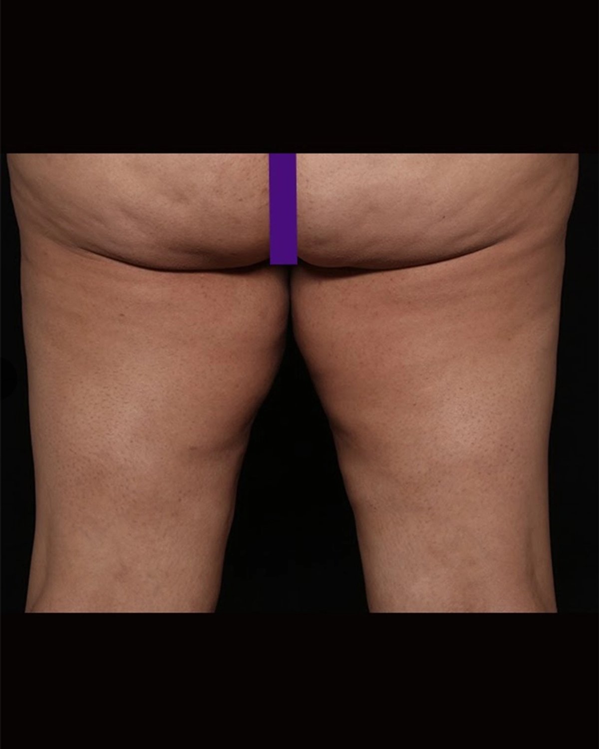 Thigh Lift (Medial) before