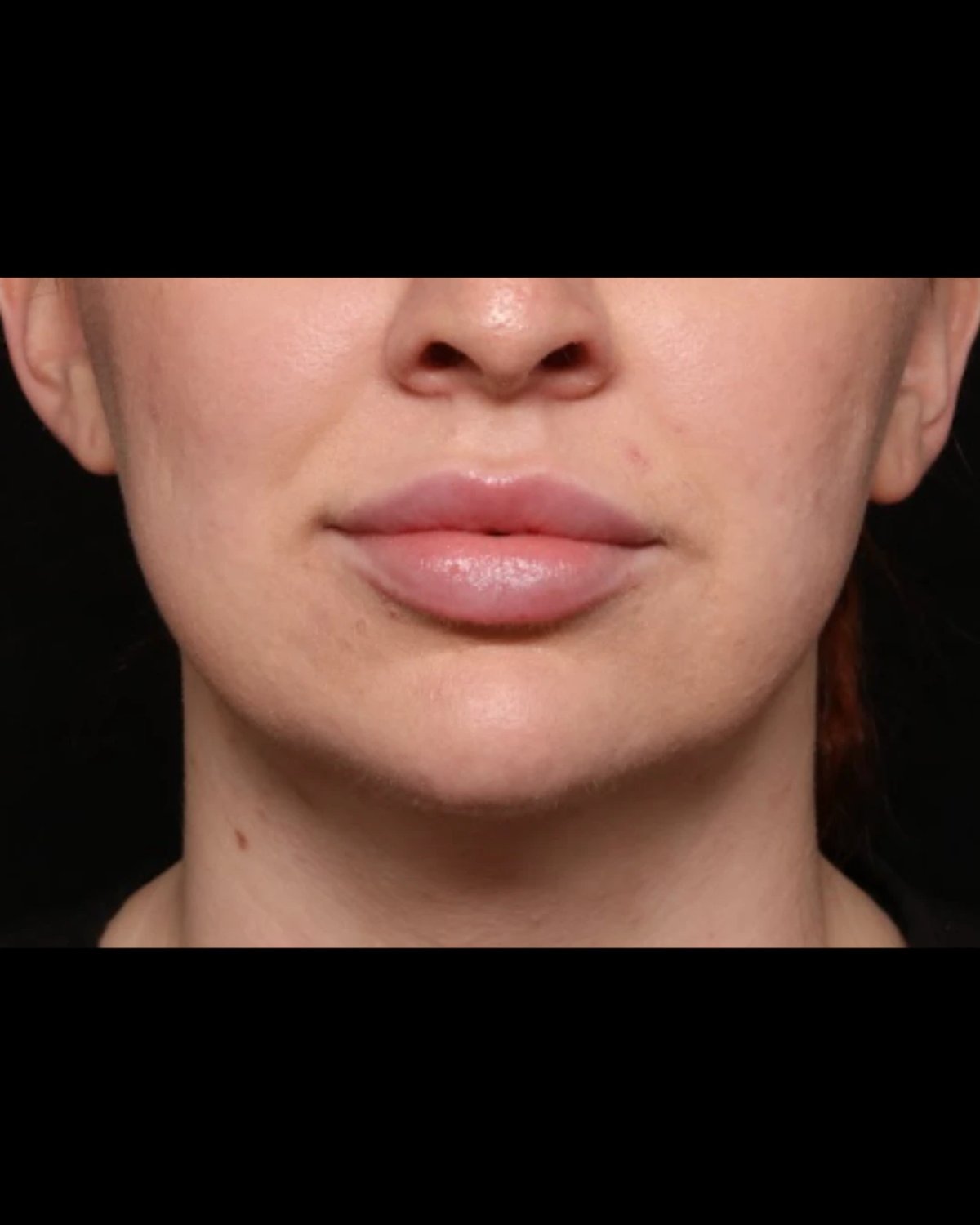 Front Liposuction (5L) (Same As Lipo360) after