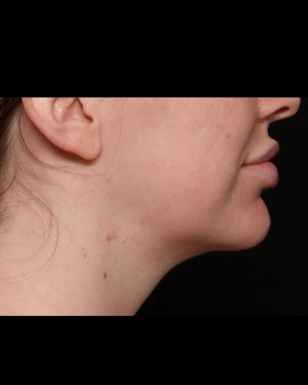 Front Liposuction (5L) (Same As Lipo360) — Right Profile view, after
