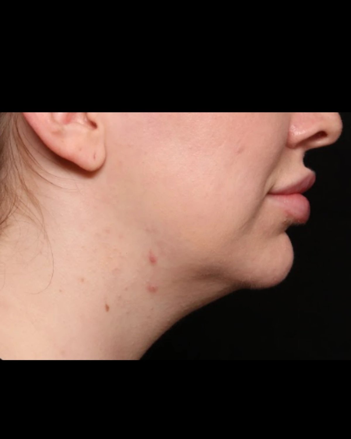 Front Liposuction (5L) (Same As Lipo360) — Right Profile view, before