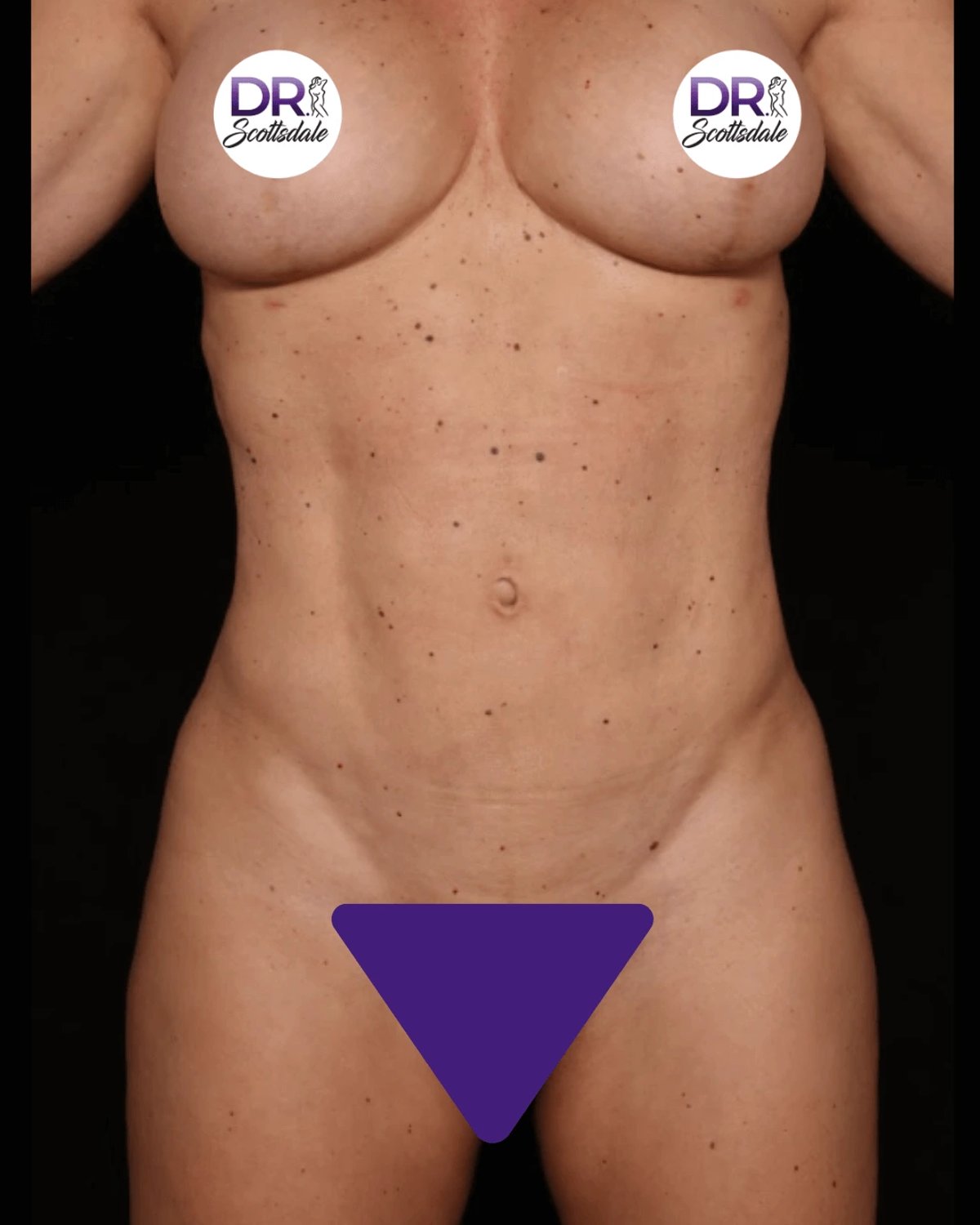 Vaser Lipo 360 (5L Max) after
