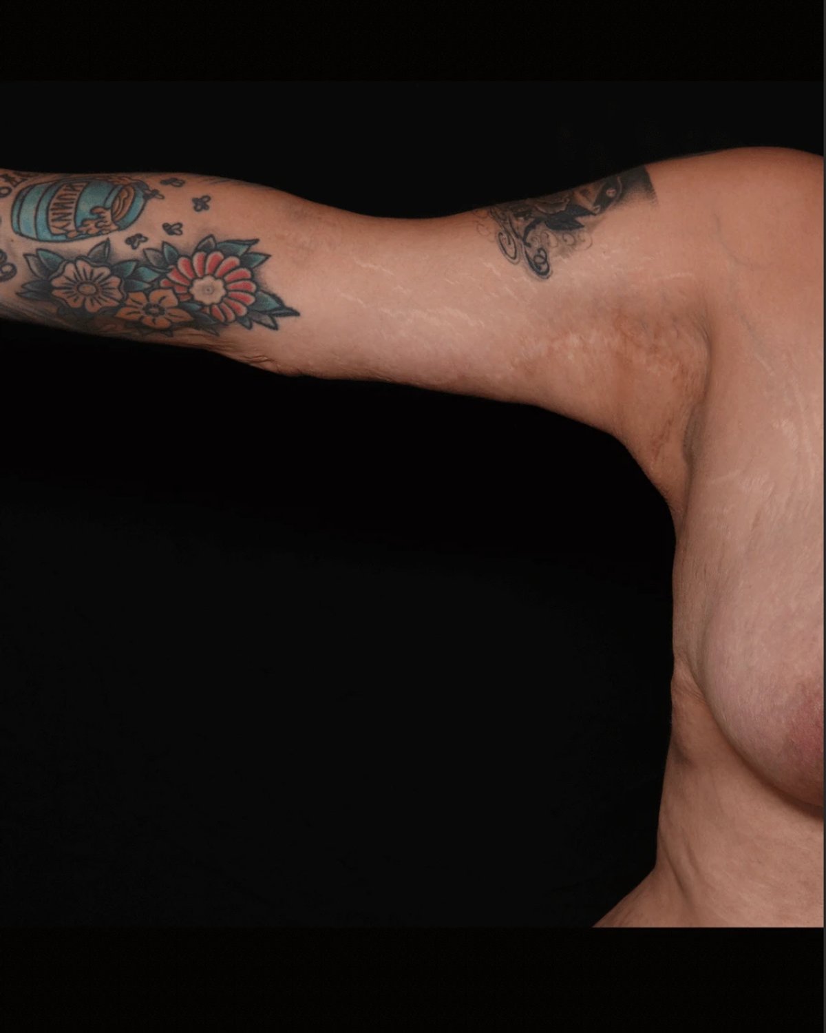 Arm Lift after