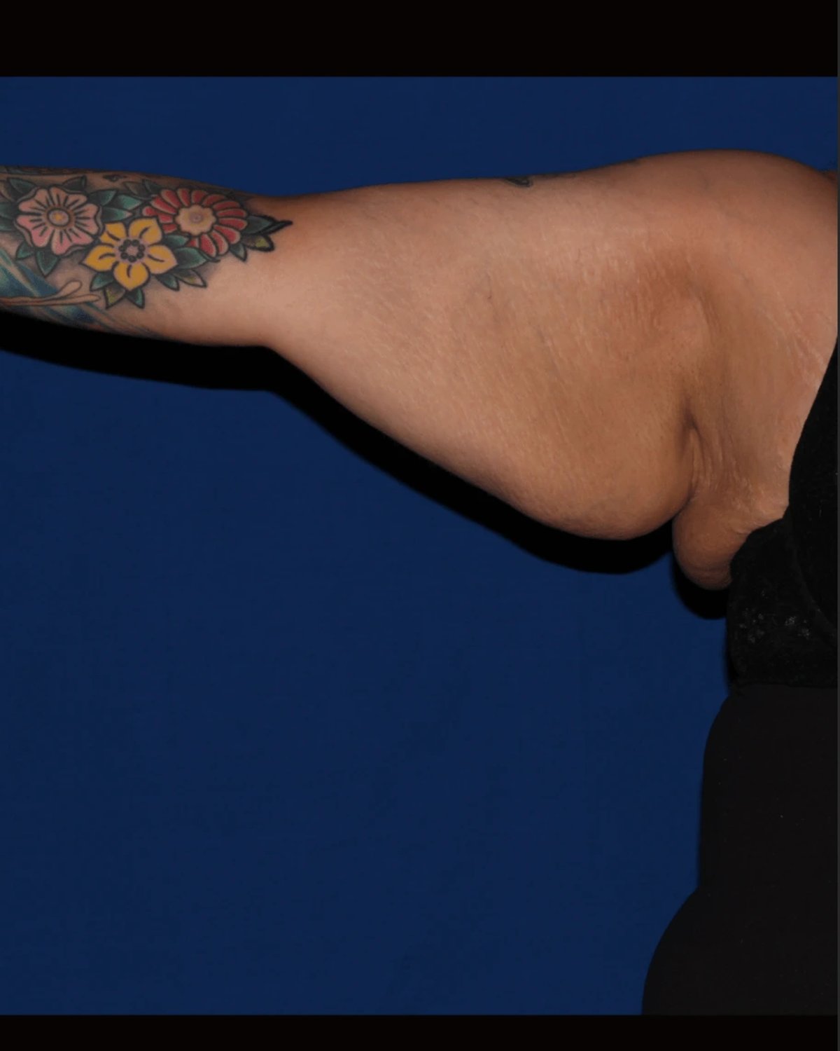 Arm Lift before