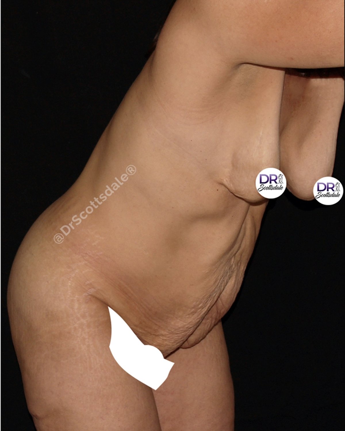 Breast Augmentation with Implants before