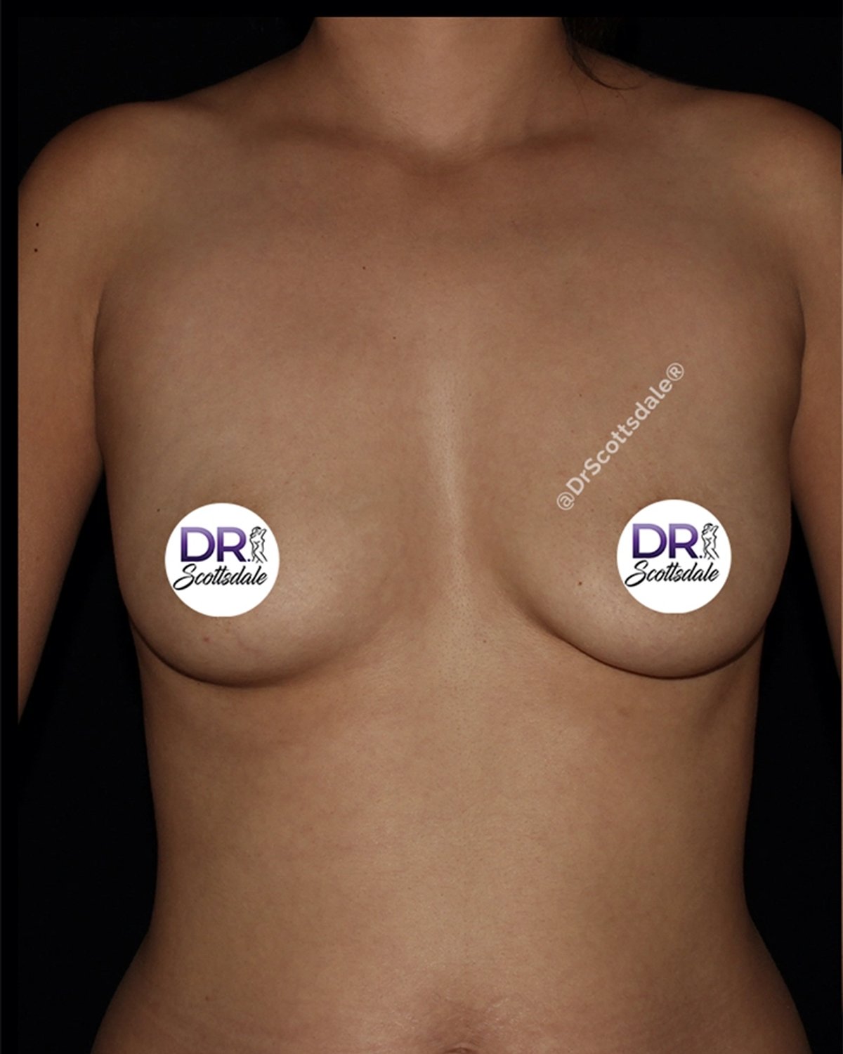 Breast Augmentation with Implants before